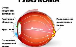 Диагностика и лечение вторичной глаукомы