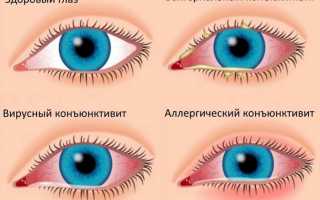 Преимущества и недостатки жёстких контактных линз