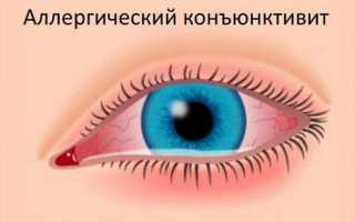 Как проявляется аллергия на глазах и чем лечится