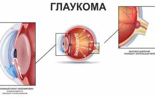 Причины, симптомы и лечение повышенного глазного давления