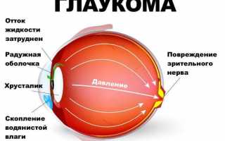 Причины и лечение выпадения полей зрения