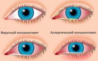 Причины покраснения глаз после наращивания ресниц и методы лечения