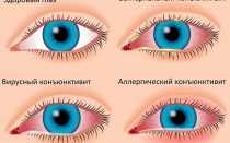 Почему опухает и болит верхнее веко глаза — причины и лечение
