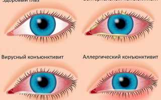 Почему опухает и болит верхнее веко глаза — причины и лечение