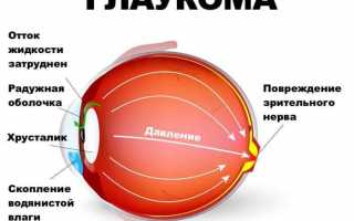 Особенности возникновения и лечения открытоугольной глаукомы
