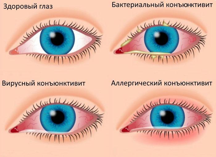 Симптоматика, сопровождающая появлением пятен на белке глаза
